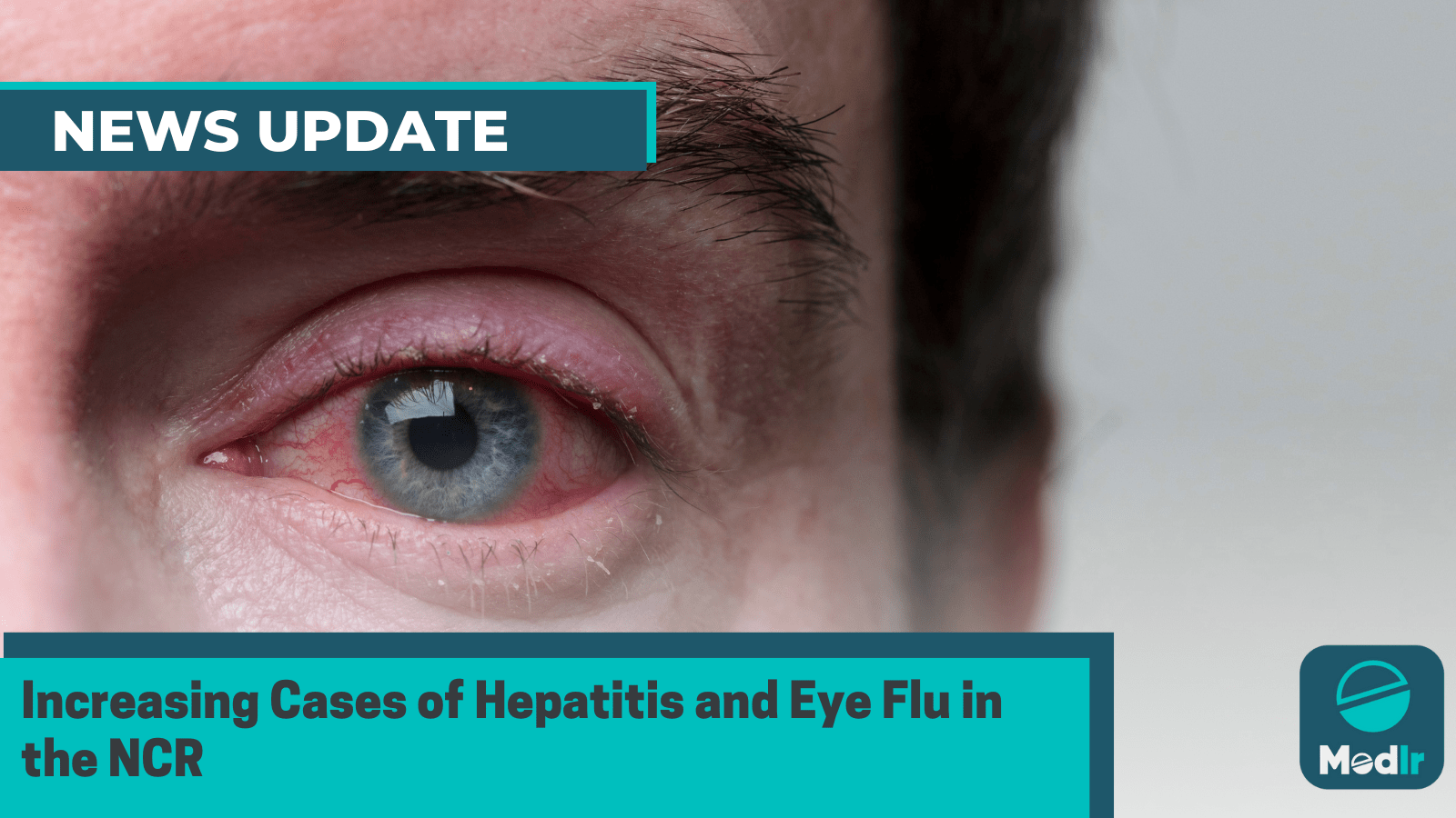 Increasing Cases of Hepatitis and Eye Flu in the NCR