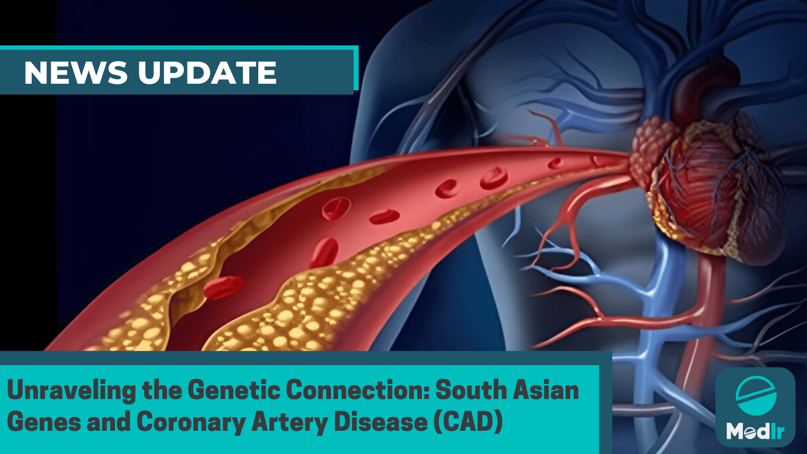 Unraveling the Genetic Connection: South Asian Genes and Coronary Artery Disease (CAD)