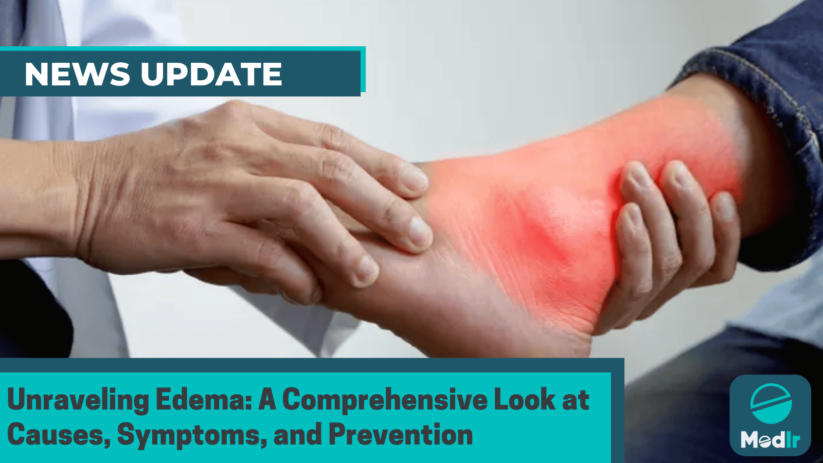 Unraveling Edema: A Comprehensive Look at Causes, Symptoms, and Prevention