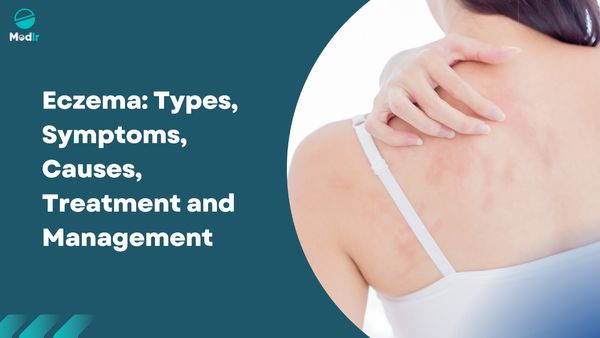 Eczema: Types, Symptoms, Causes, Treatment and Management